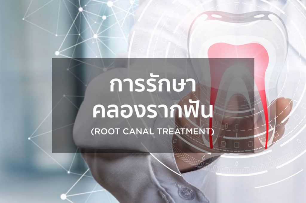 การรักษาคลองรากฟัน