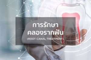 การรักษาคลองรากฟัน